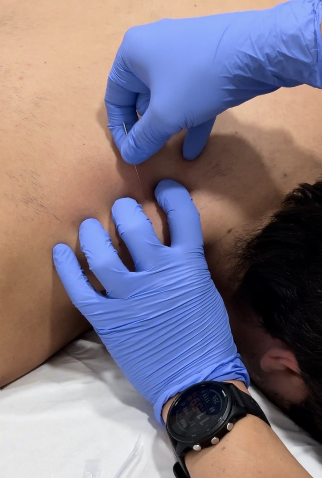 Terapia invasiva punción seca Aljarafe